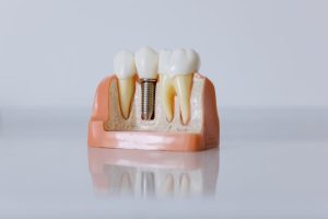 dental implants mascot