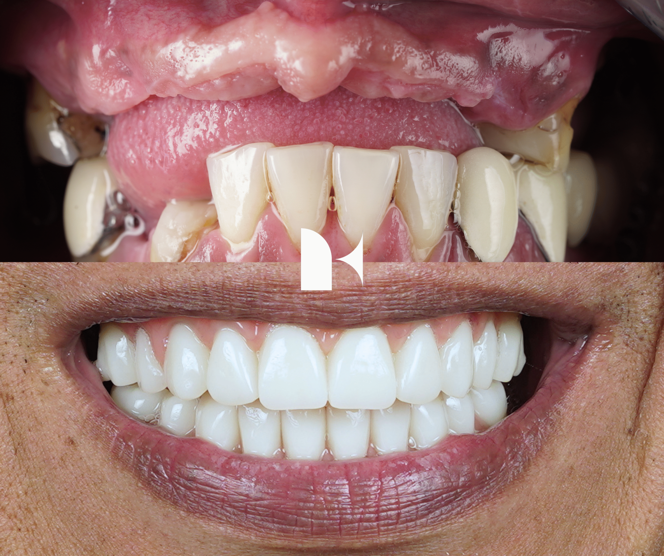 Treatment: All On 4 Dental Implants
Result: 2 weeks post-procedure