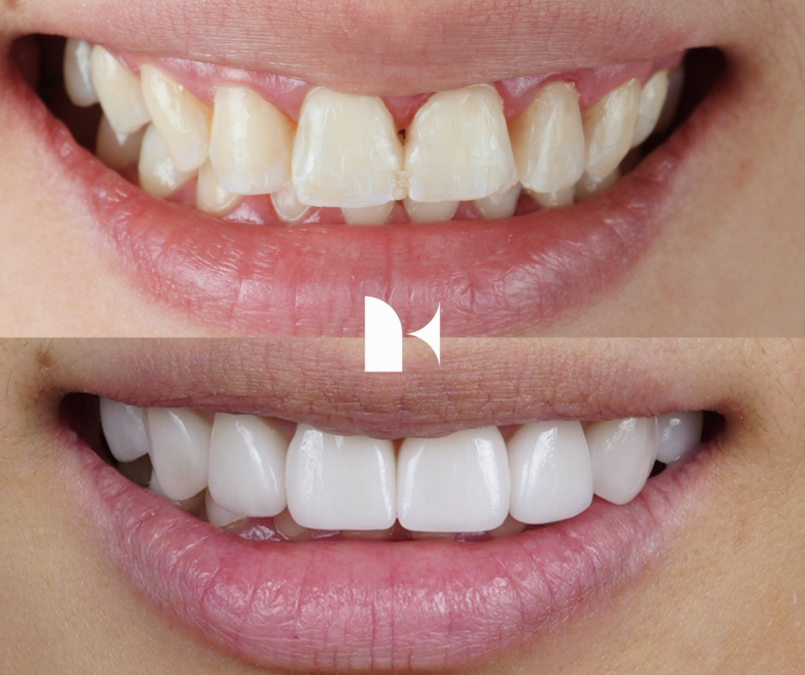 Treatment: Porcelain Veneers
Result: 3 months post-procedure