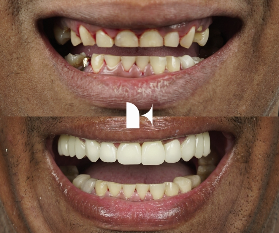 Treatment: Porcelain Veneers
Result: 3 months post-procedure