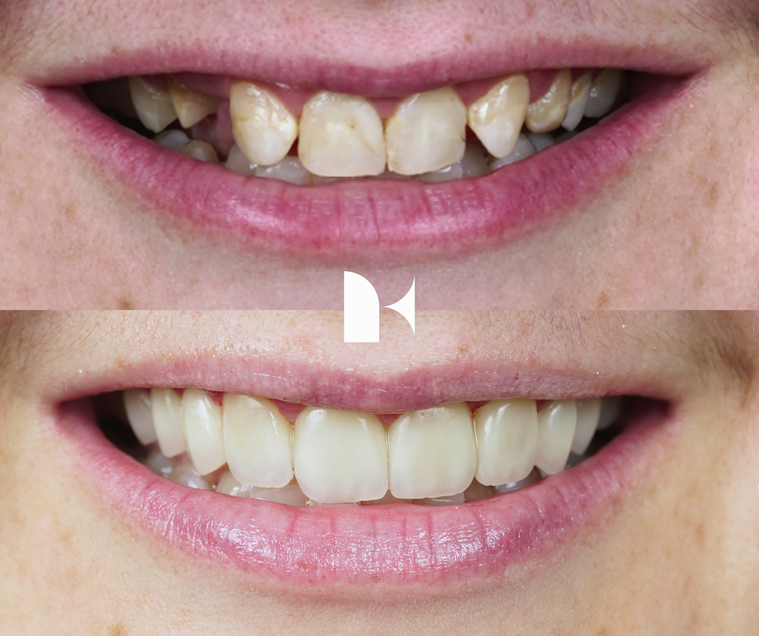 Treatment: Porcelain Veneers
Result: 3 months post-procedure