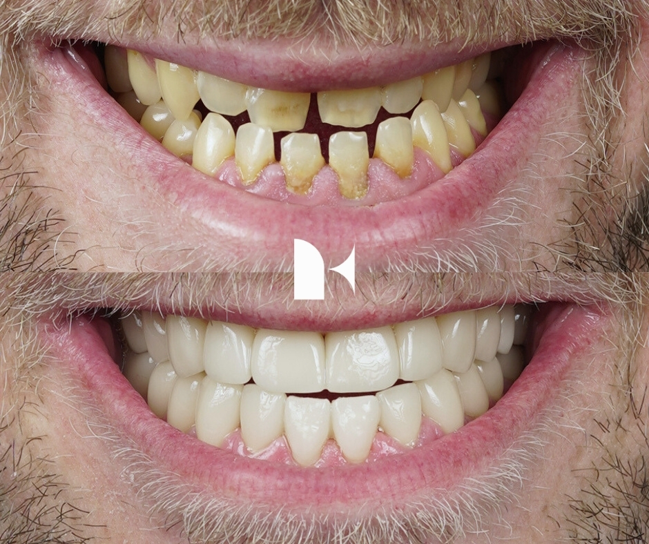 Treatment: Porcelain Veneers
Result: 3 months post-procedure