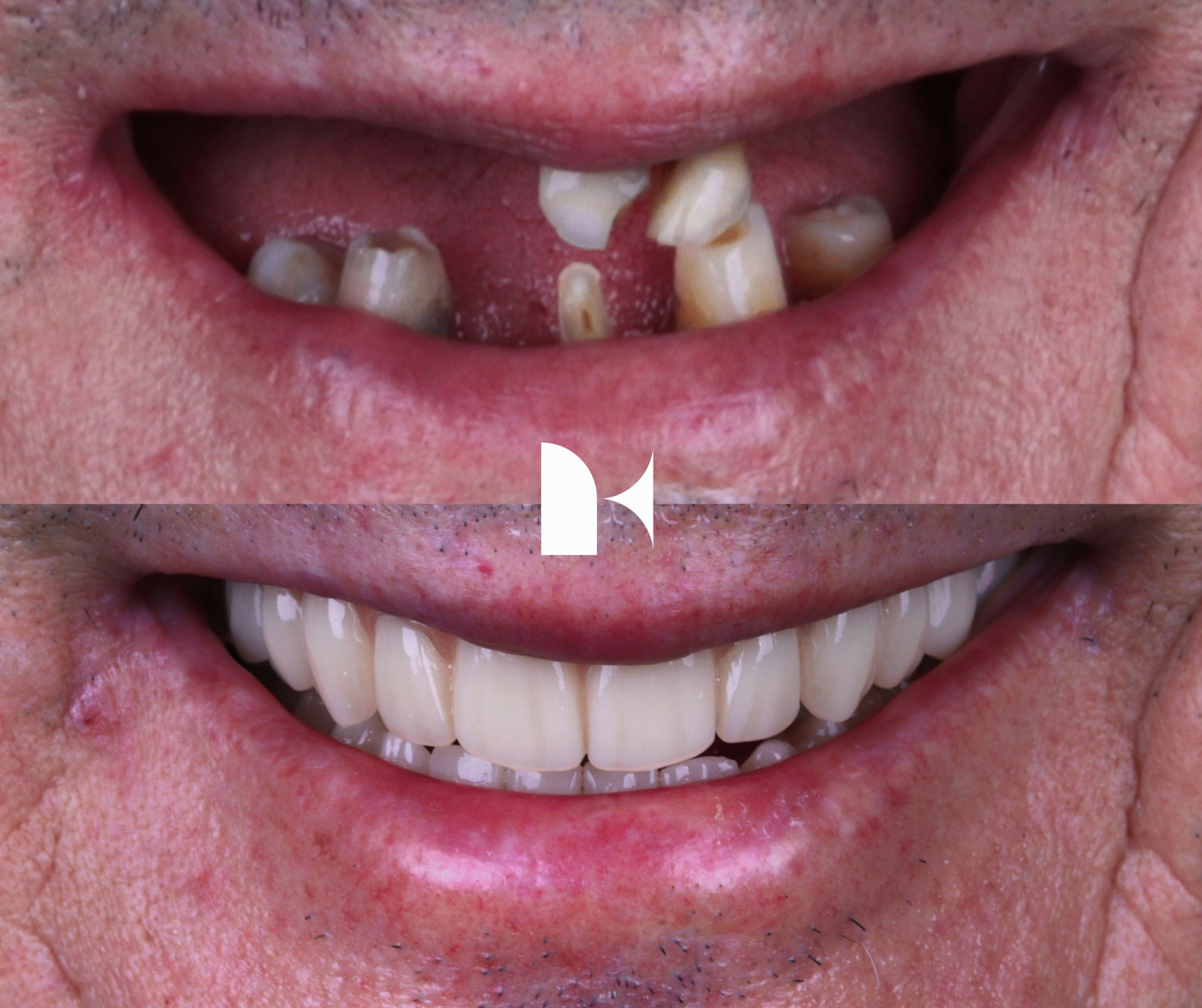 Treatment: All On 4 Dental Implants
Result: 3 months post-procedure