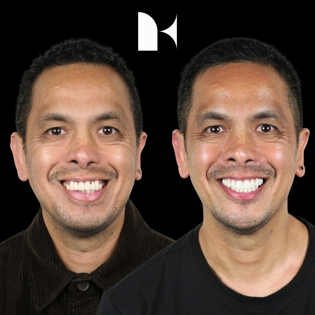 Treatment: All On 4 Dental Implants
Result: 3 months post-procedure