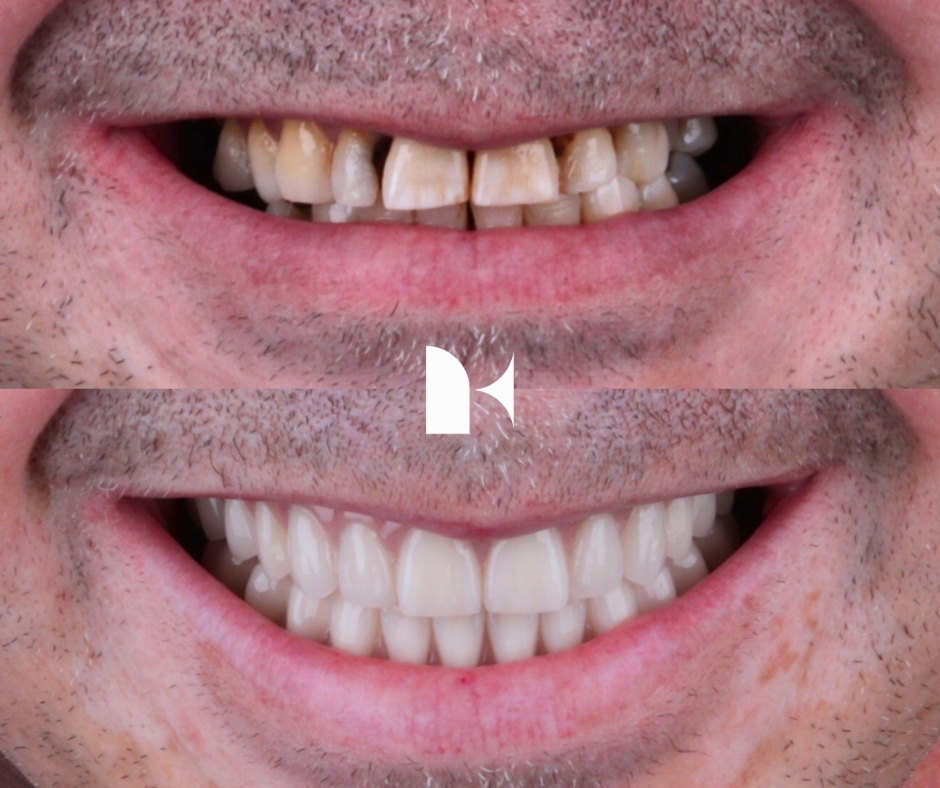 Treatment: All On 4 Dental Implants
Result: 3 months post-procedure