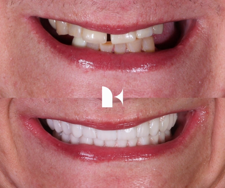 Treatment: All On 4 Dental Implants
Result: 3 months post-procedure