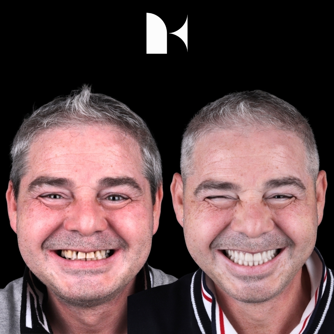 Treatment: All On 4 Dental Implants
Result: 3 months post-procedure