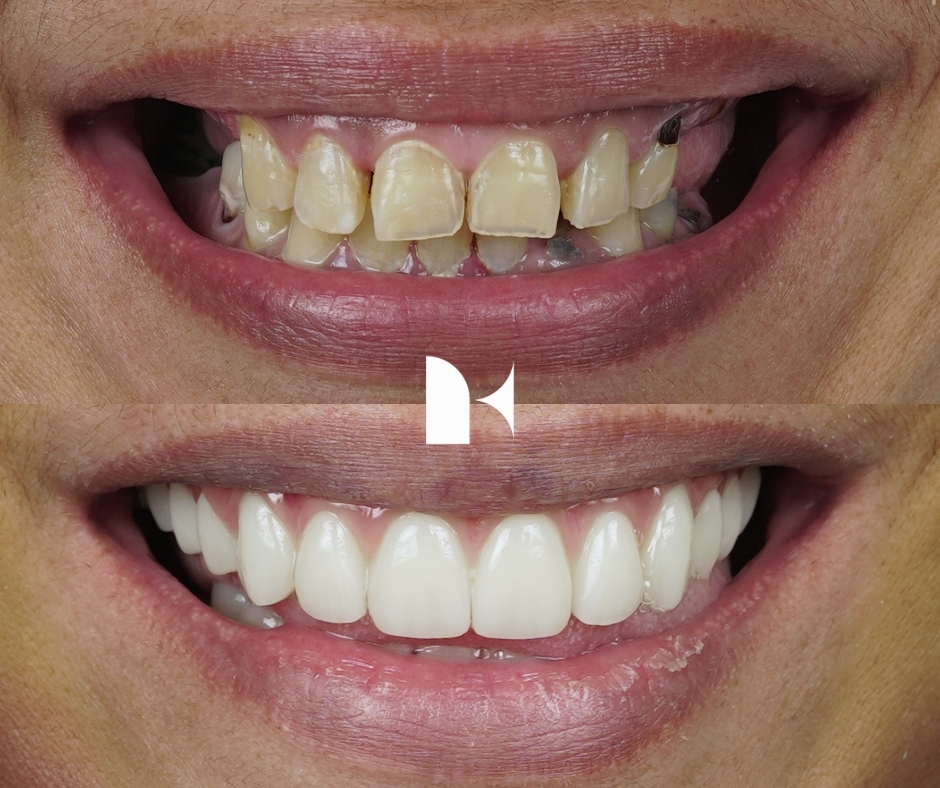 Treatment: All On 4 Dental Implants
Result: 2 days post-procedure