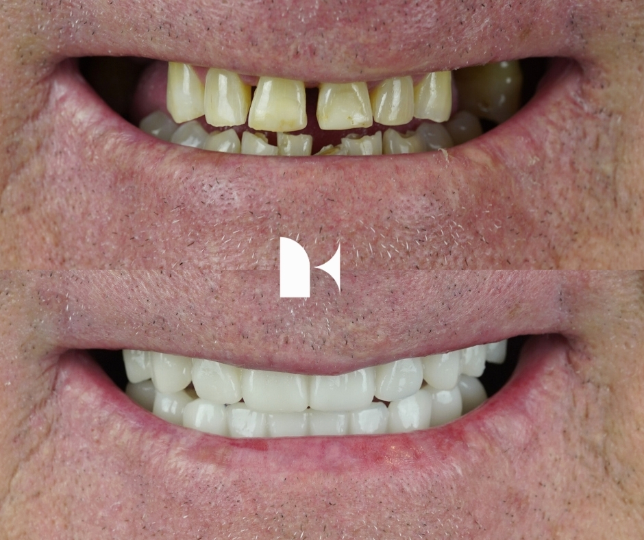 Treatment: All On 4 Dental Implants
Result: 3 days post-procedure