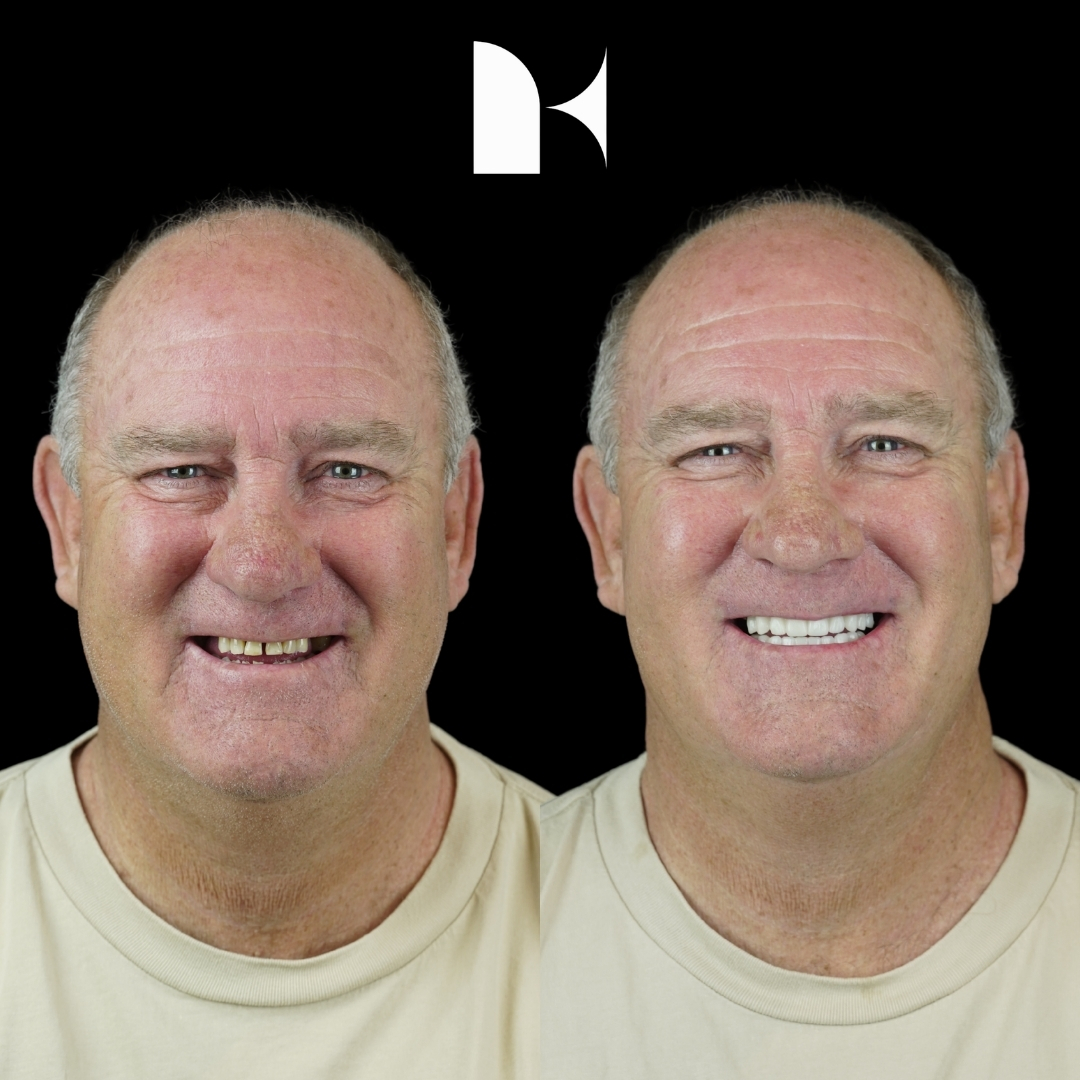 Treatment: All On 4 Dental Implants
Result: 3 days post-procedure