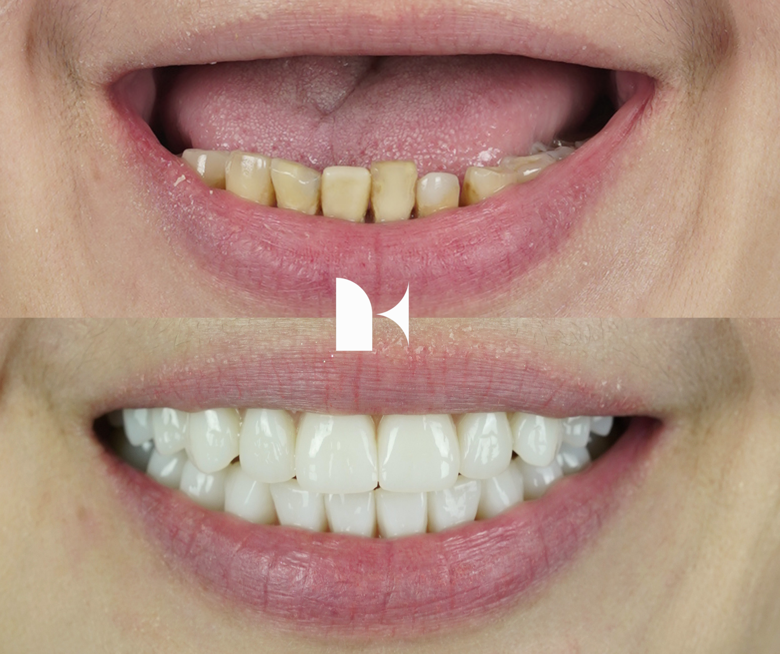Treatment: All On 4 Dental Implants
Result: 3 months post-procedure