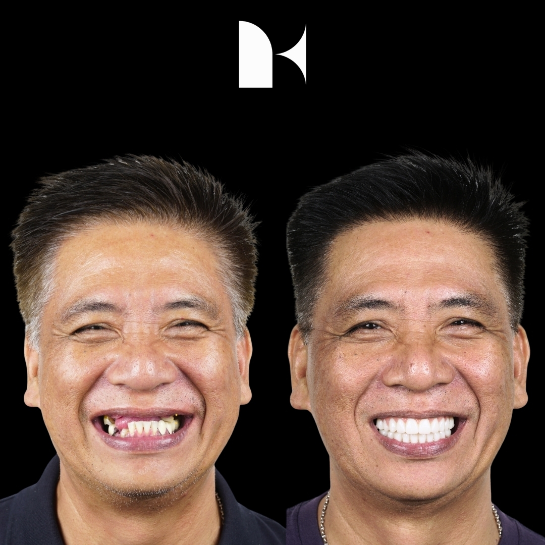Treatment: All On 4 Dental Implants
Result: 2 weeks post-procedure
