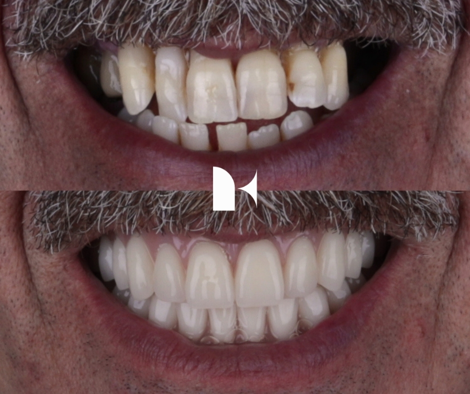 Treatment: All On 4 Dental Implants
Result: 3 months post-procedure