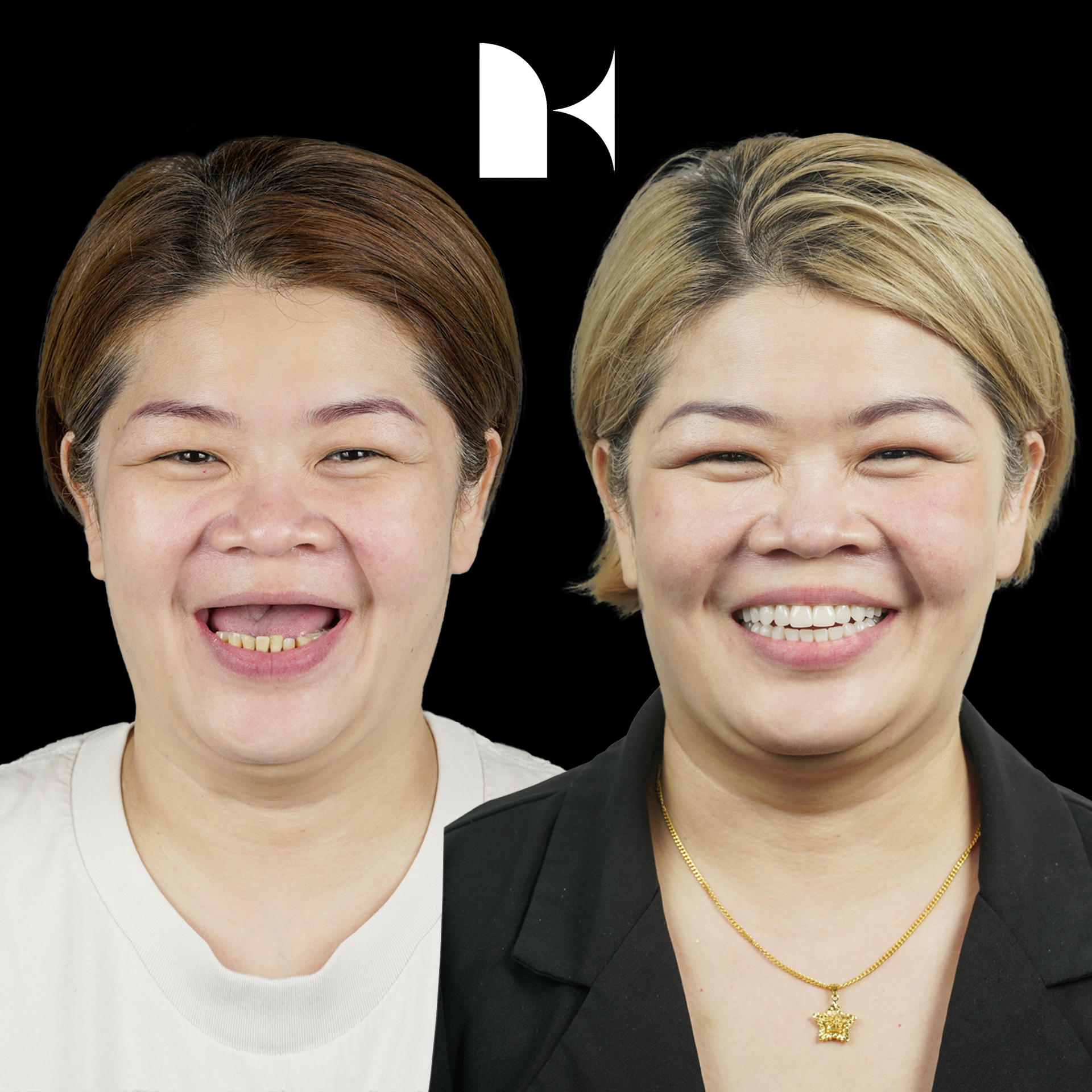 Treatment: All On 4 Dental Implants
Result: 3 months post-procedure