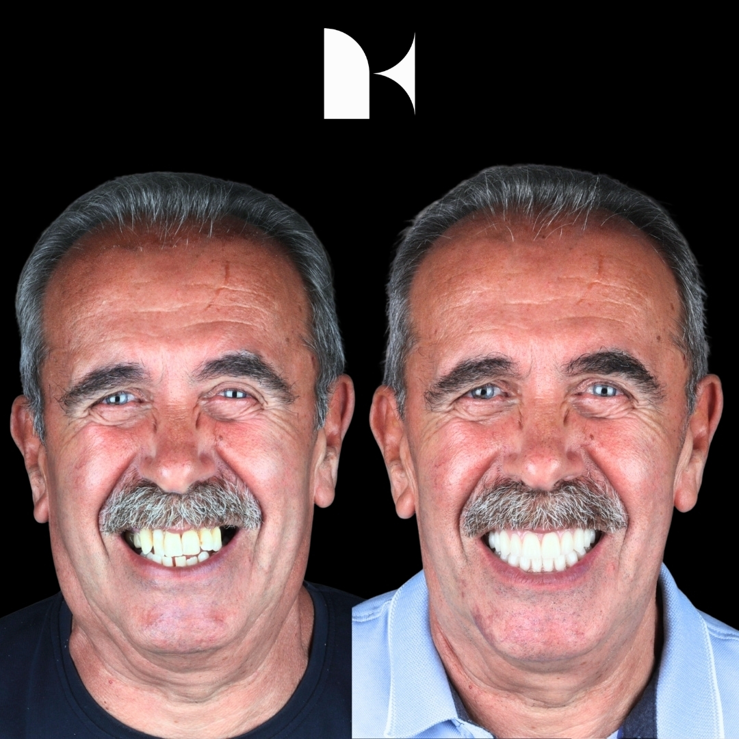 Treatment: All On 4 Dental Implants
Result: 3 months post-procedure