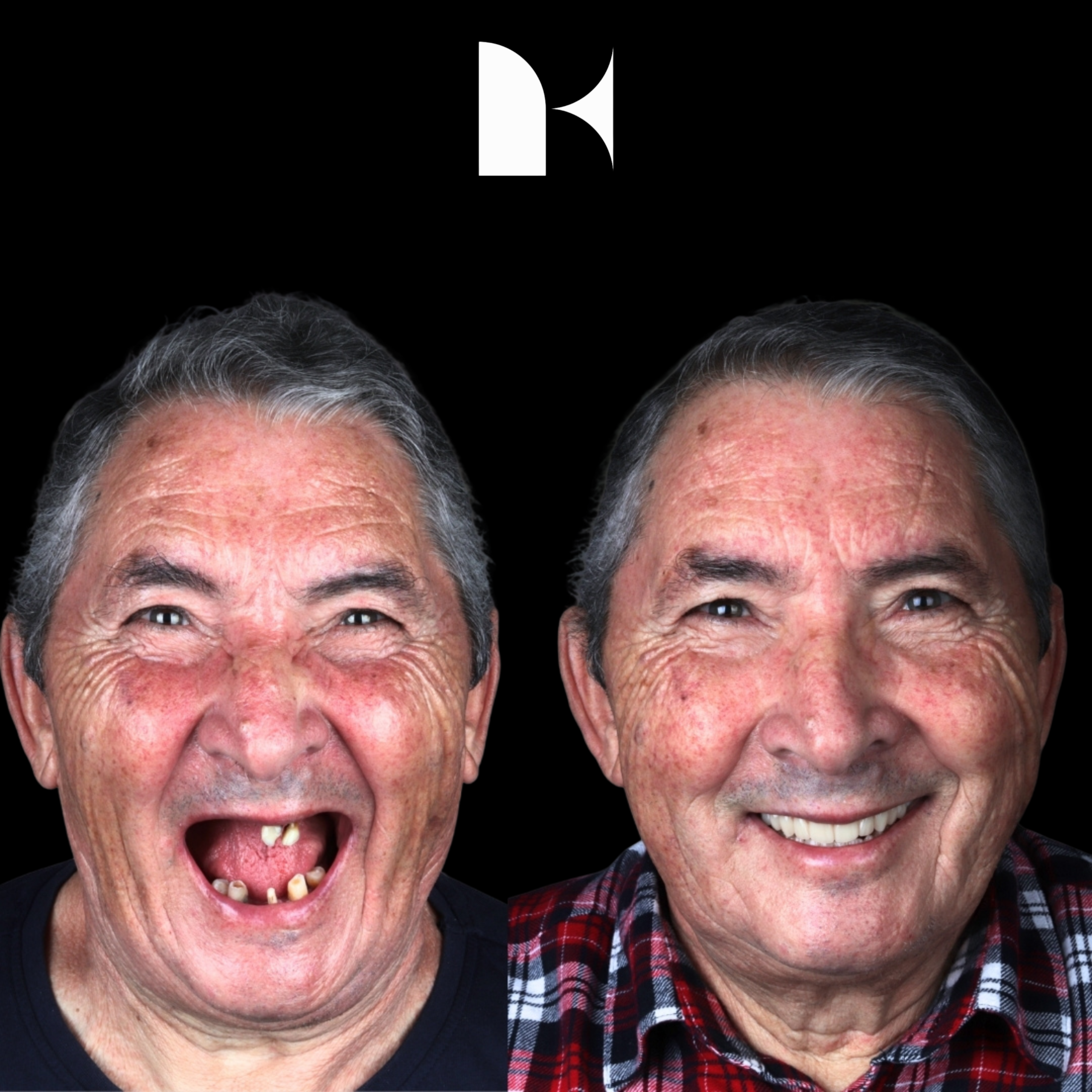 Treatment: All On 4 Dental Implants
Result: 3 months post-procedure