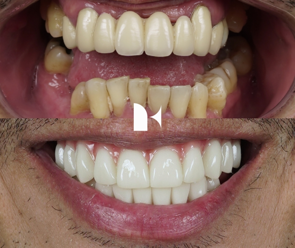 Treatment: All On 4 Dental Implants
Result: 3 months post-procedure