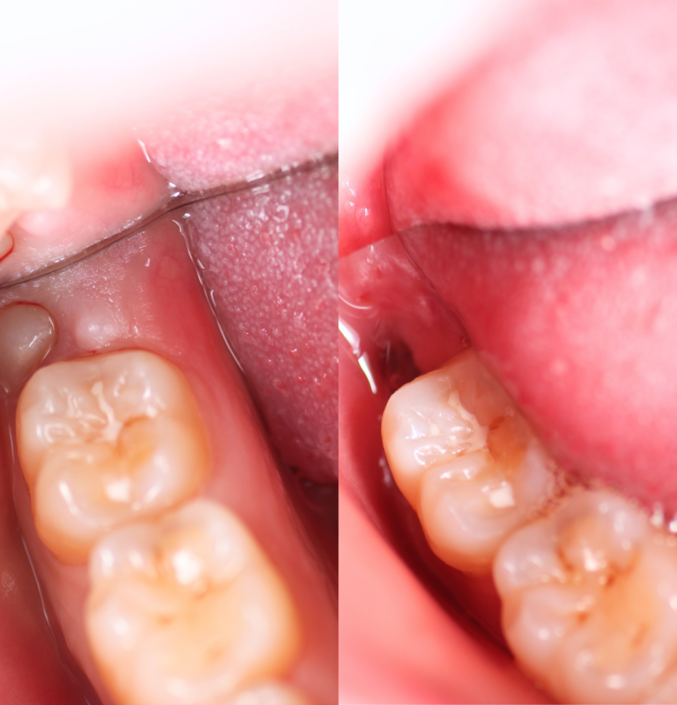 emergency dental treatment for toothache at kita dental, sydney