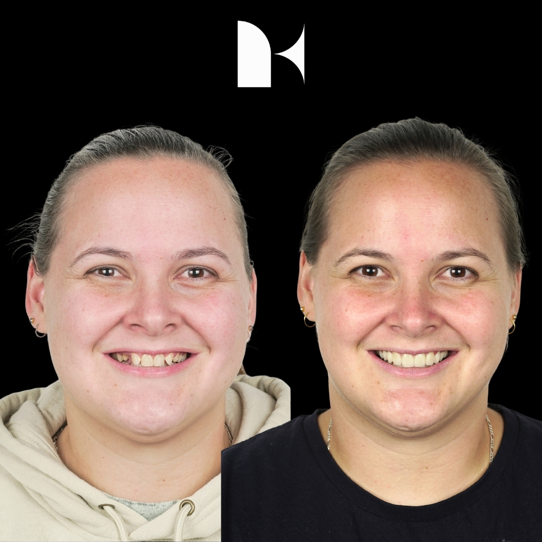 Treatment: Porcelain Veneers
Result: 3 months post-procedure