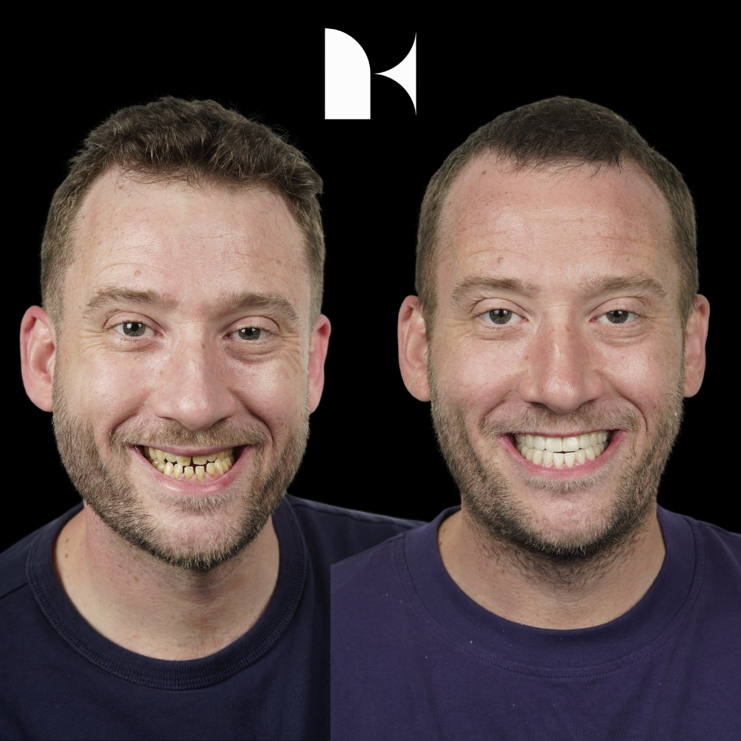 Treatment: Porcelain Veneers
Result: 3 months post-procedure