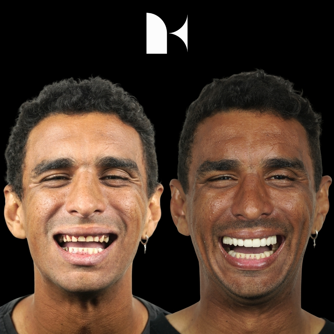 Treatment: Porcelain Veneers
Result: 3 months post-procedure