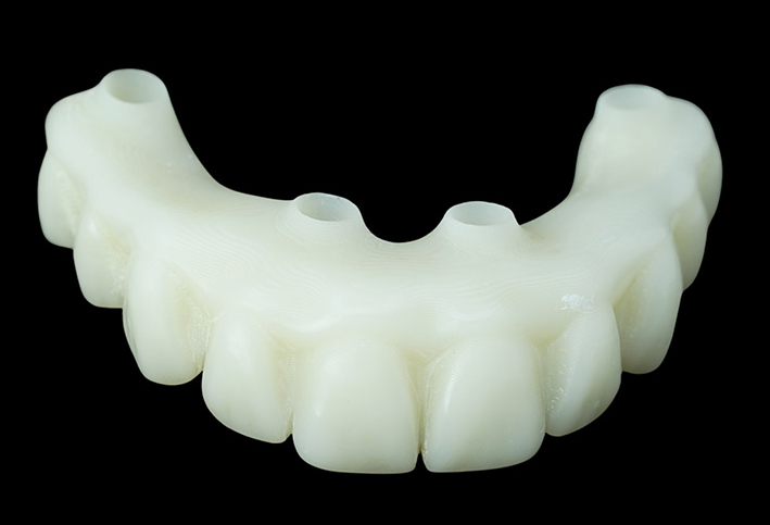 all on 4 teeth made from 3D-acrylic printed resin materials
