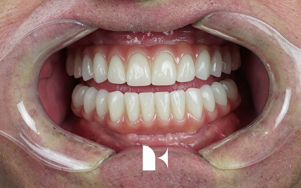 all on 4 dental implant final teeth placed at Kita Dental in patient's mouth