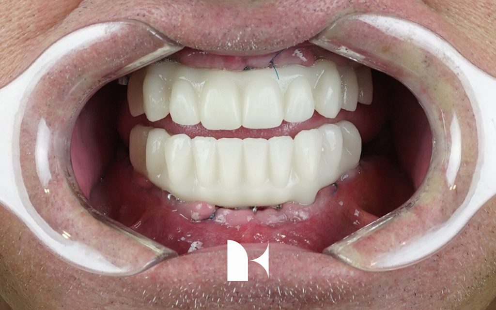all on 4 dental implant temporary teeth placed within 24-hours at Kita Dental in patient's mouth