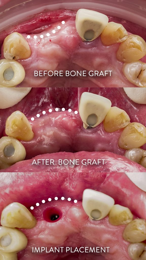 diagram showing bone grafting for complex dental implant cases