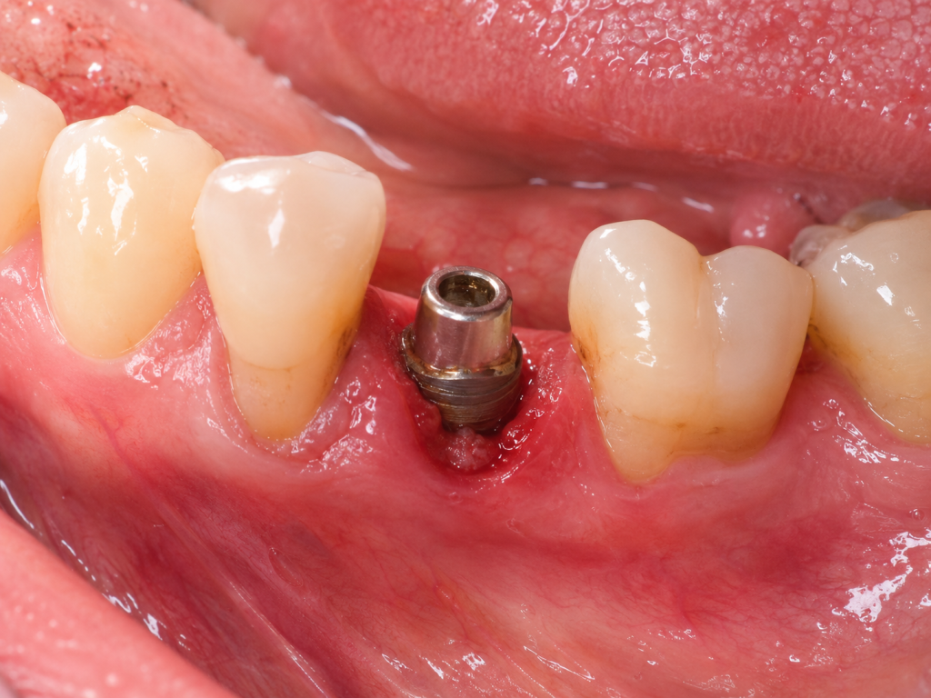 a guide to options for when dental implants fail