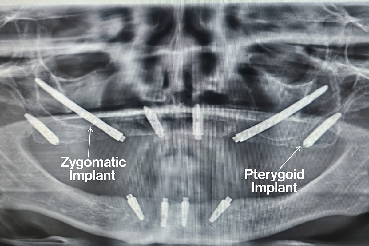 x-ray scan showing how zygomatic treatment works for complex cases needing dental implants